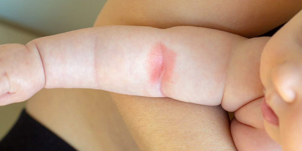 síntomas de la dermatitis atópica