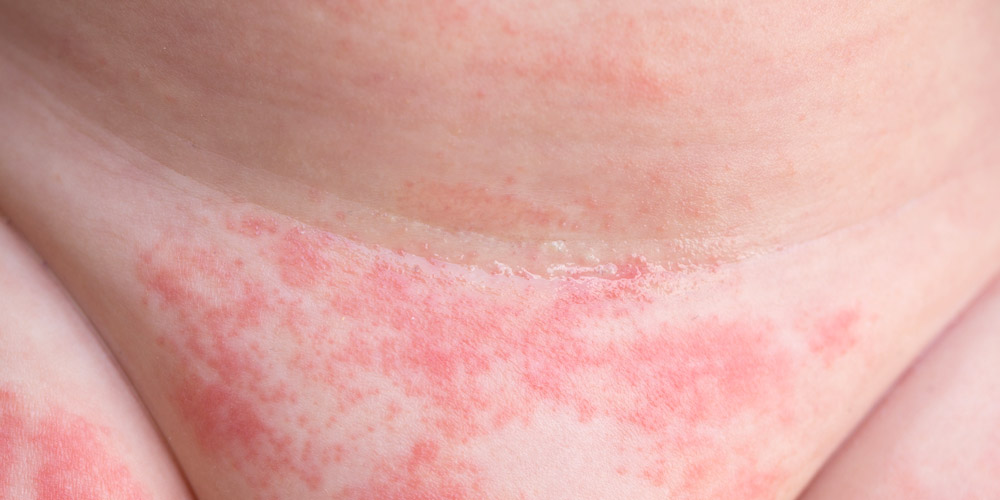 síntomas de la dermatitis de pañal