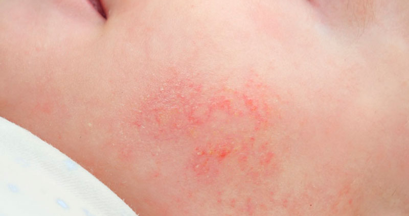 dermatitis-atopica o eccema