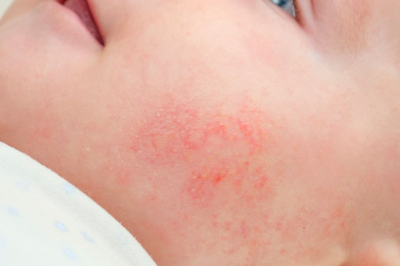 Dermatitis atópica o eccema tópico